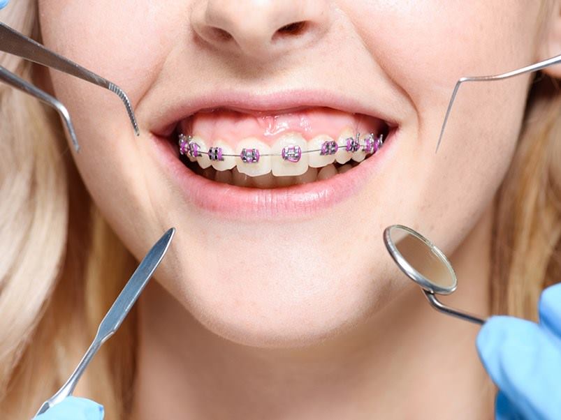 ortodoncia-herramientas-dentales-mujer